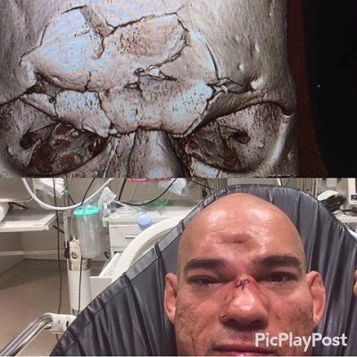 Evangelista Cyborg sofreu afundamento de crânio após nocaute de Michael Page